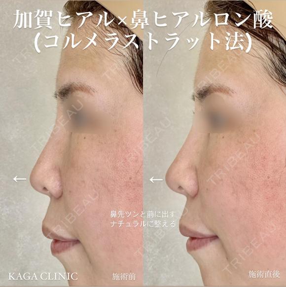 加賀ヒアル×コルメラストラット法 after画像 メイン用