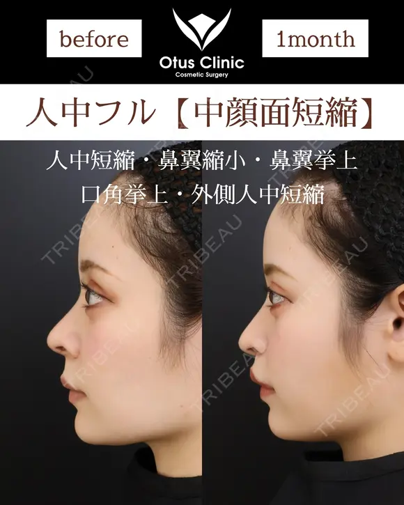 人中フル【人中短縮・鼻翼縮小・鼻翼挙上・口角挙上・外側人中短縮】 before画像 メイン用