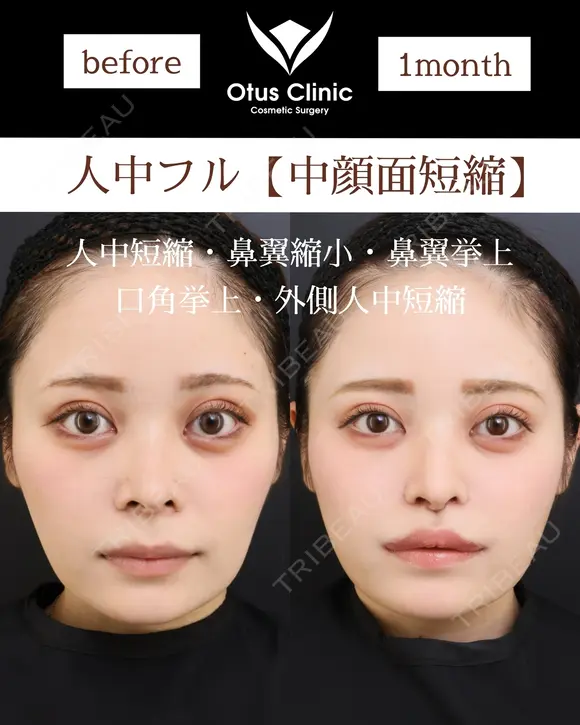 人中フル【人中短縮・鼻翼縮小・鼻翼挙上・口角挙上・外側人中短縮】 30日後 メイン用