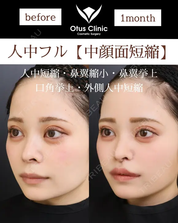 人中フル【人中短縮・鼻翼縮小・鼻翼挙上・口角挙上・外側人中短縮】 30日後 メイン用
