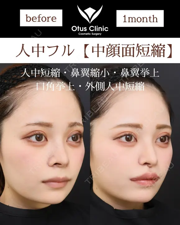 人中フル【人中短縮・鼻翼縮小・鼻翼挙上・口角挙上・外側人中短縮】 30日後 メイン用
