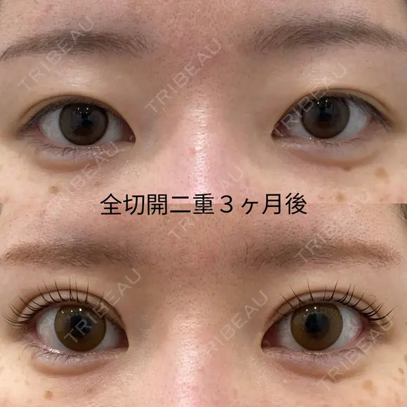 二重全切開 90日後 メイン用