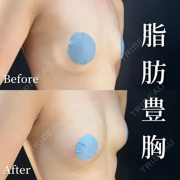 脂肪豊胸 before画像 メイン用
