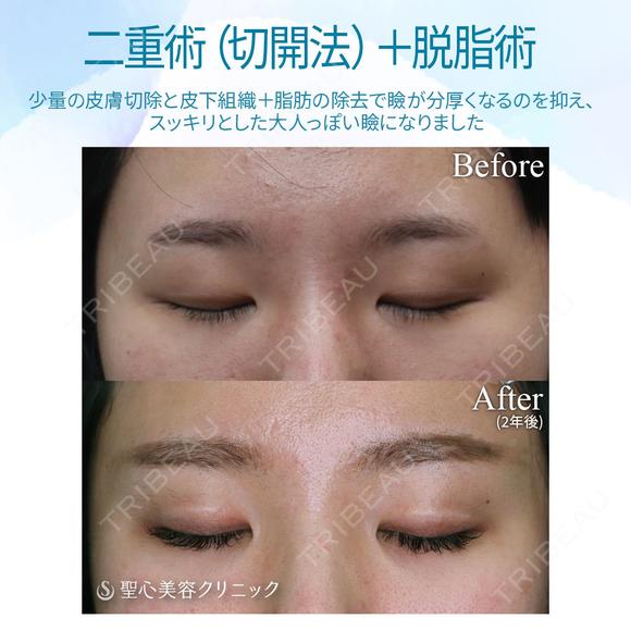 【20代女性・スッキリした二重まぶたへ】二重術（切開法）＋脱脂術（2年後） after画像 メイン用