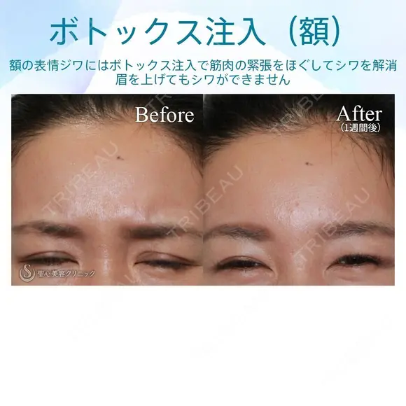 【30代女性・眉間のしわを改善】眉間ボトックス（1週間後） before画像 メイン用