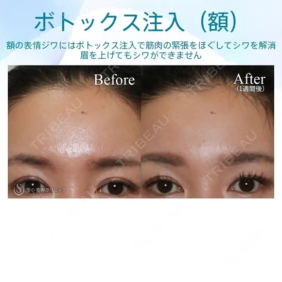 【30代女性・眉間のしわを改善】眉間ボトックス（1週間後） after画像 メイン用
