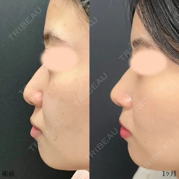 鼻尖形成3D法、軟骨移植、MD式 before画像 メイン用
