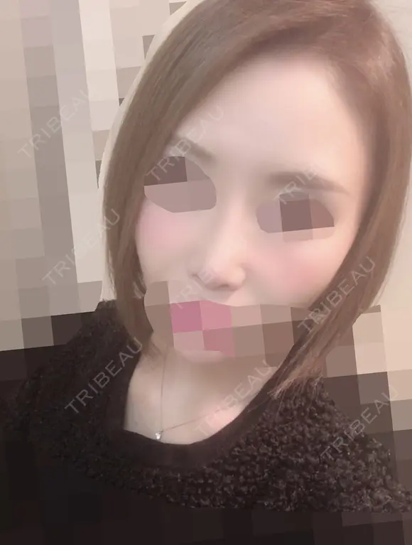 鼻の手術 before画像 メイン用