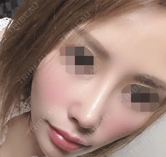 鼻の手術 28日後 メイン用