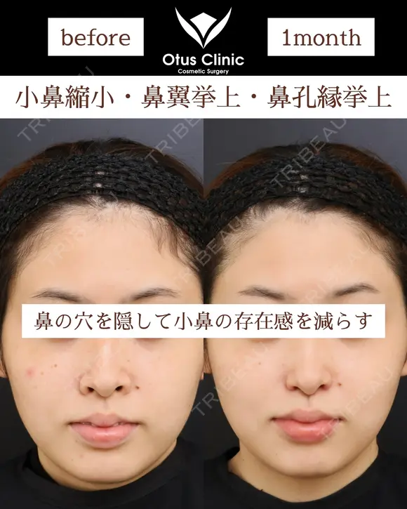 小鼻縮小・鼻翼挙上・鼻孔縁挙上 30日後 メイン用