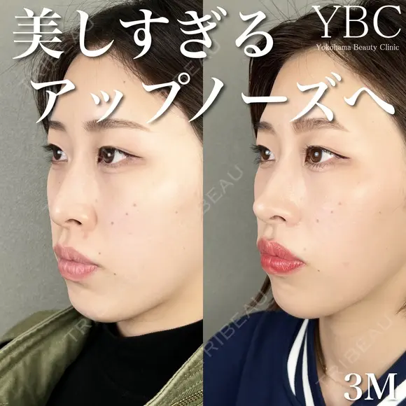 【🌼鼻尖形成🌼】 after画像 メイン用