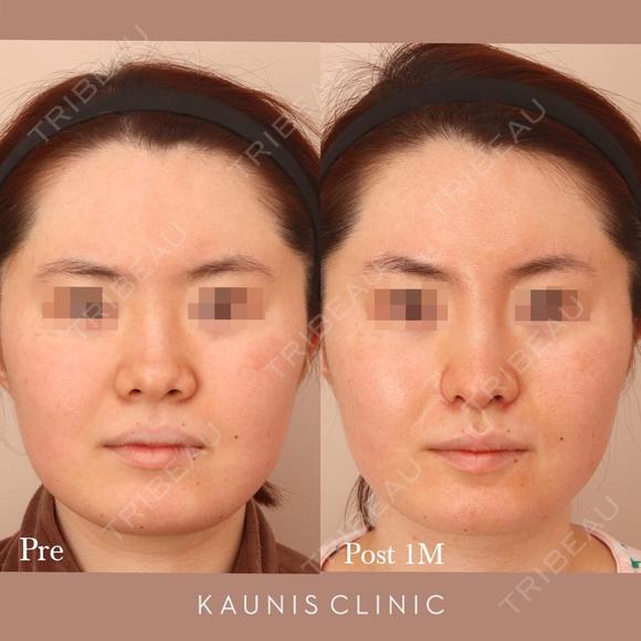 鼻中隔延長、鼻翼縮小(内側)  after画像 メイン用