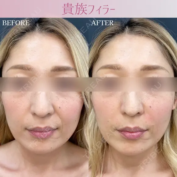 貴族フィラー before画像 メイン用