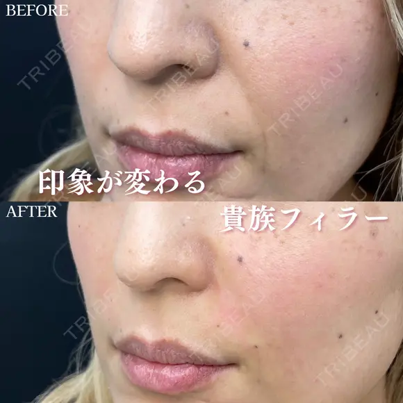 貴族フィラー 0日後 メイン用