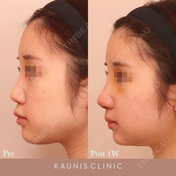鼻中隔延長、他院鼻プロテーゼ加工、他院修正 before画像 メイン用