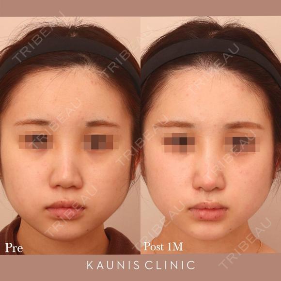 鼻中隔延長、他院鼻プロテーゼ加工、他院修正 after画像 メイン用
