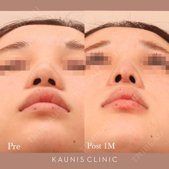 鼻中隔延長、他院鼻プロテーゼ加工、他院修正 after画像 メイン用