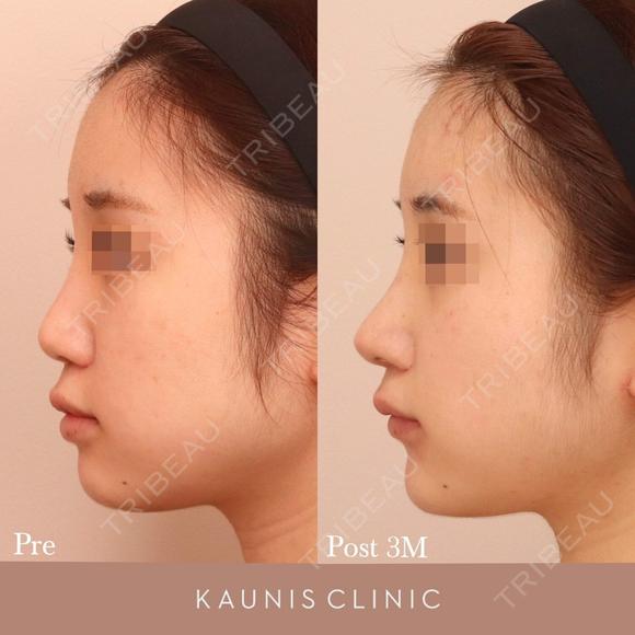 鼻中隔延長、他院鼻プロテーゼ加工、他院修正 after画像 メイン用