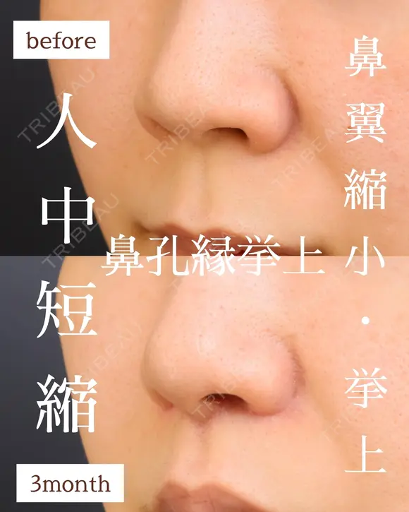 人中短縮・小鼻縮小・鼻翼挙上・鼻孔縁挙上 90日後 メイン用
