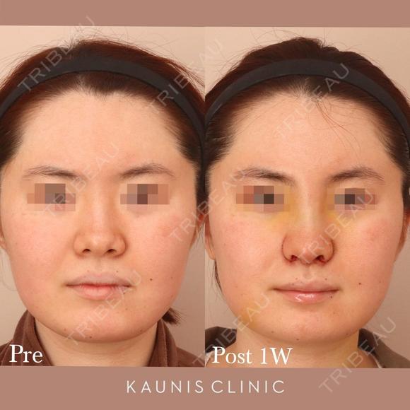 鼻中隔延長、鼻翼縮小(内側) before画像 メイン用