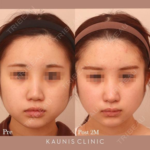 鼻中隔延長、他院鼻プロテーゼ加工、他院修正 after画像 メイン用
