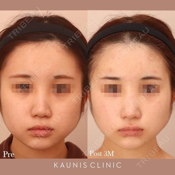 鼻中隔延長、他院鼻プロテーゼ加工、他院修正 after画像 メイン用