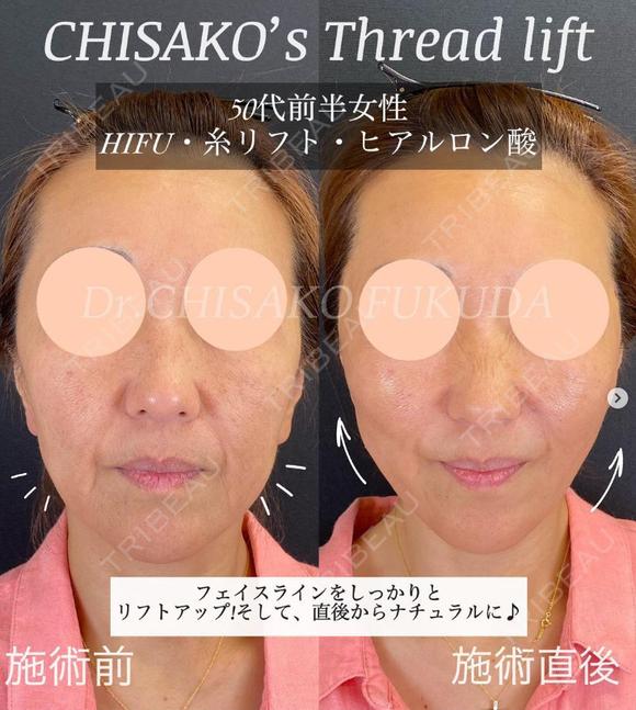 糸リフトとヒアルロン酸で直後からこんなに綺麗！ after画像 メイン用