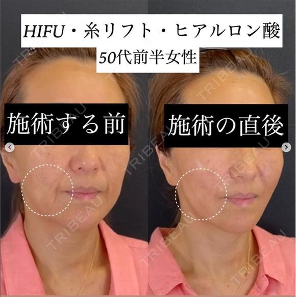 アンチエイジングならお任せください。40代。糸リフトとヒアルロン酸で直後からこんなに綺麗！口元横もすっきり。 after画像 メイン用