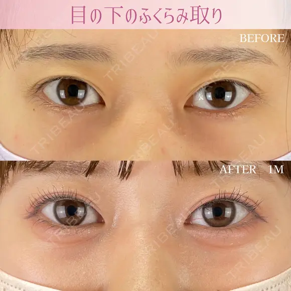 目の下のふくらみ取り before画像 メイン用