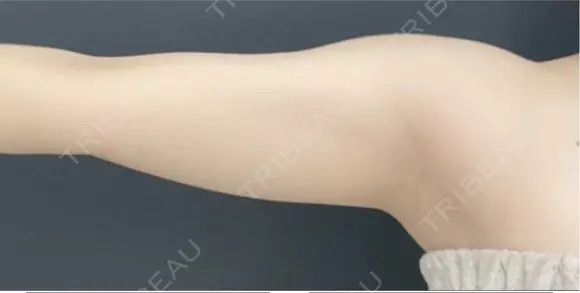 二の腕脂肪吸引 before画像 メイン用