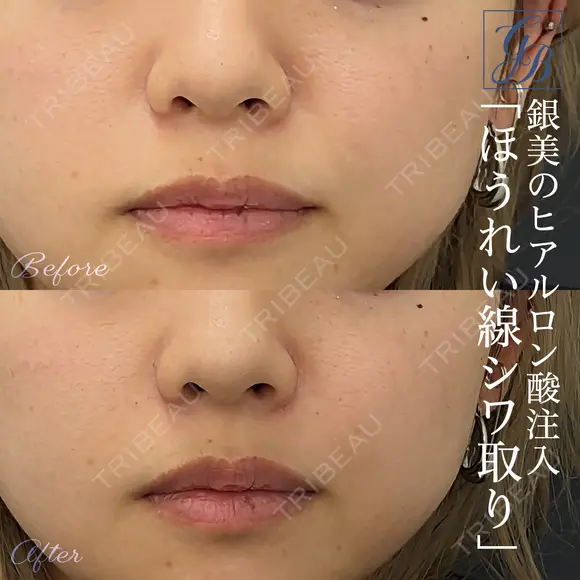 貴族フィラー｜ヒアルロン酸注入（ほうれい線） after画像 メイン用