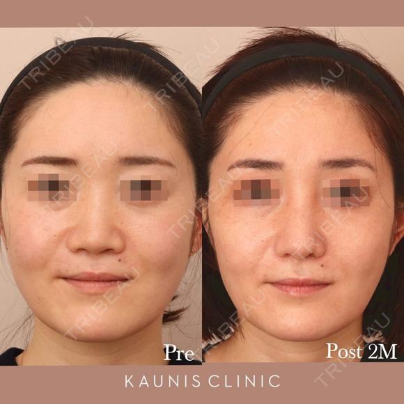 鼻中隔延長、隆鼻(オーダーメイドプロテーゼ)、鼻翼縮小(内側) after画像 メイン用