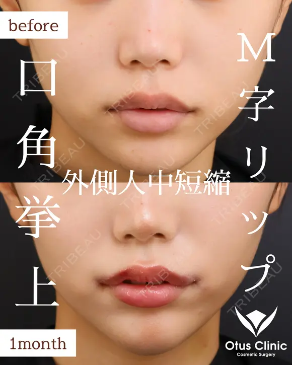 口角挙上・M字リップ・外側人中短縮 before画像 メイン用