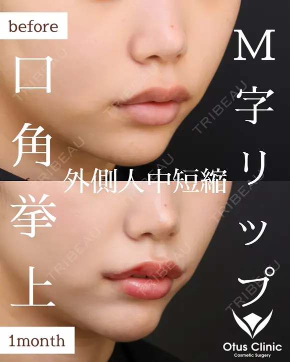 口角挙上・M字リップ・外側人中短縮 30日後 メイン用