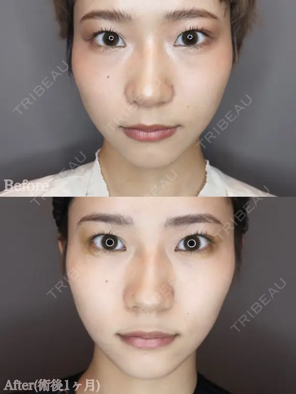 エラのボトックス after画像 メイン用