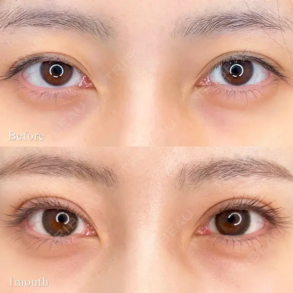 二重埋没(クイックシンデレラ・ダブル) before画像 メイン用