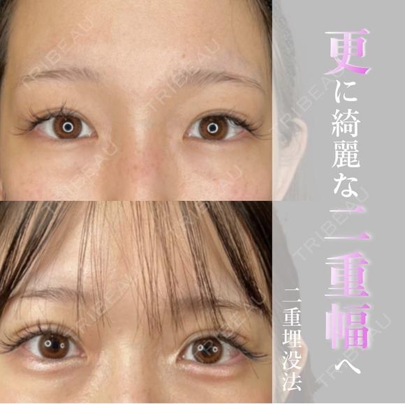 二重埋没｜ナチュレクイック法 after画像 メイン用