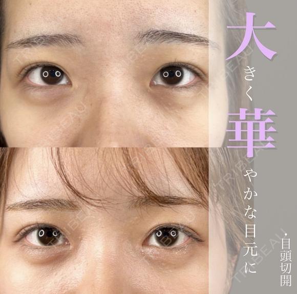 目頭切開 after画像 メイン用