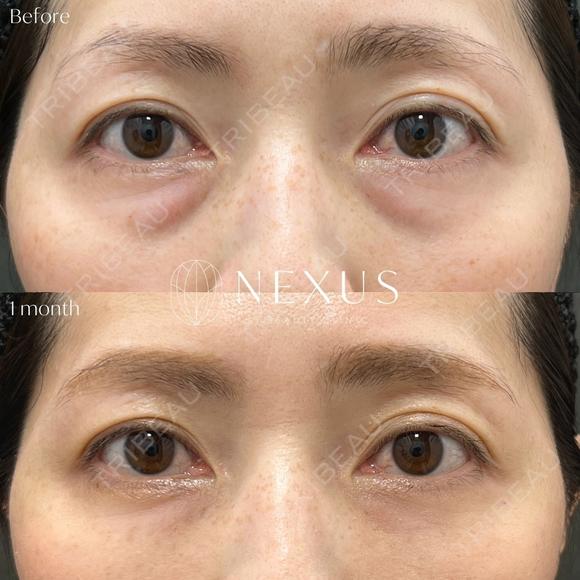 裏ハムラ法＋脂肪注入 before画像 メイン用