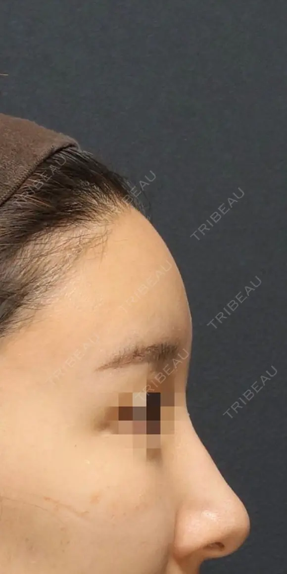 脂肪注入でSライン形成 after画像 メイン用