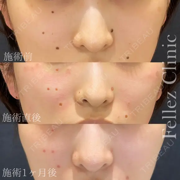 当院人気No1🌟ホクロ３個18,000円 after画像 メイン用