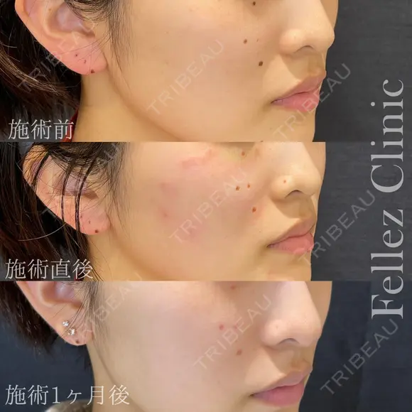 当院人気No1🌟ホクロ３個18,000円 before画像 メイン用