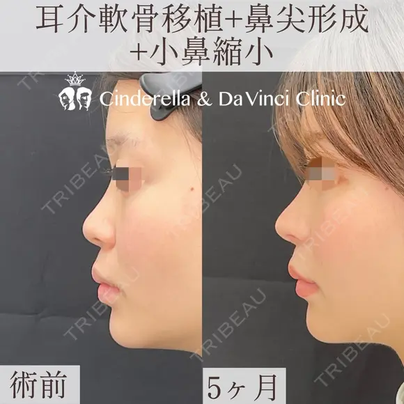 鼻の印象をなくして忘れ鼻に before画像 メイン用