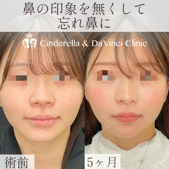 鼻の印象をなくして忘れ鼻に after画像 メイン用