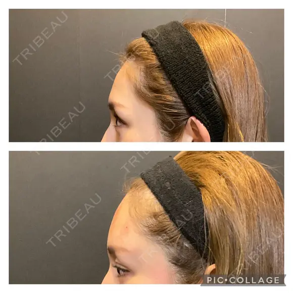 ヒアルロン酸注入　額 after画像 メイン用