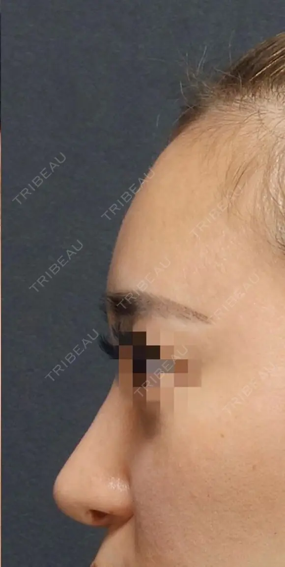 Sライン形成: 額 脂肪注入 after画像 メイン用