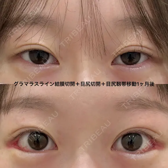 皮膚を切らない後戻り最小のグラマラスライン（グラマラスライン結膜切開＋目尻切開＋目尻靭帯移動） 30日後 メイン用