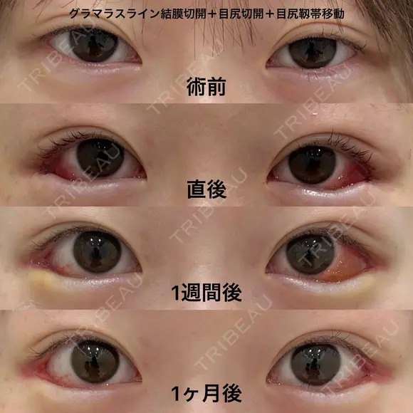 皮膚を切らない後戻り最小のグラマラスライン（グラマラスライン結膜切開＋目尻切開＋目尻靭帯移動） after画像 メイン用