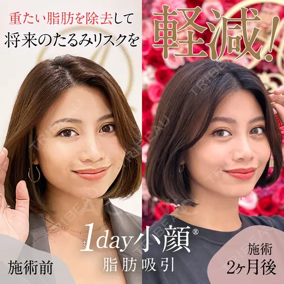 【1day小顔】重たい脂肪を除去して洗練された顔立ちに♪ before画像 メイン用