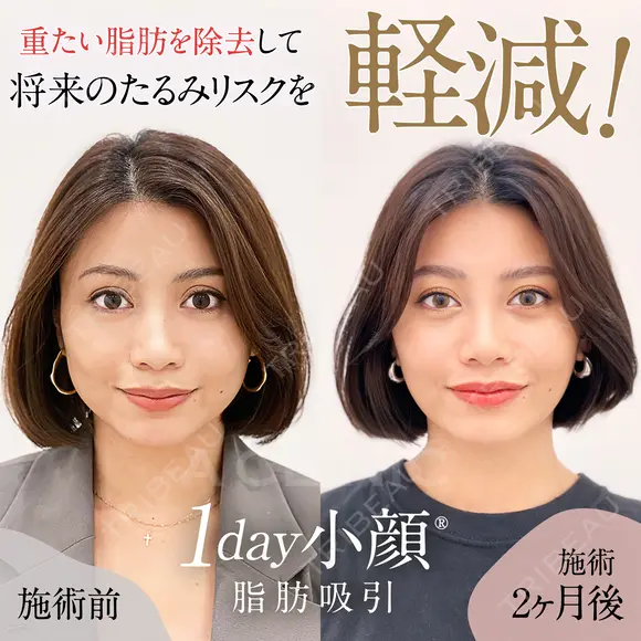 【1day小顔】ダウンタイム少なく垢抜ける♪ before画像 メイン用